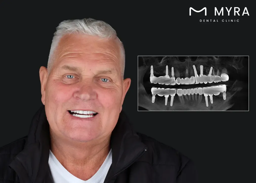How Do All-on-4 Dental Implants Work.webp